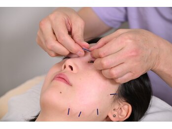 かつらはりきゅう 小児しん/必要な場所に必要な数の美容鍼