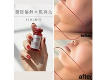 トータルビューティーサロン リリ(Riri)の雰囲気（美肌・脂肪分解お顔全体が引き締まります！次世代型脂肪分解！）