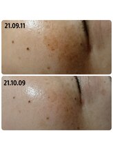 ロコモ 美容矯正サロン(Locomo)/シミケアフェイシャルくすみ改善