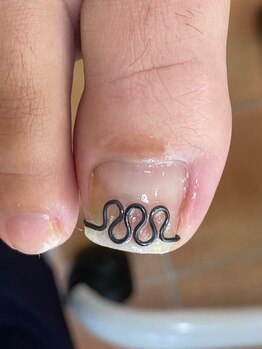 ツメフラ法（軽度～重度まで）