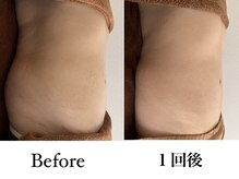 エフプラネット(F Planet)/スライドカッピング＋リンパ