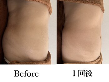 エフプラネット(F Planet)/スライドカッピング＋リンパ