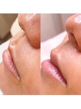 エミレ(emire)/(お口周り)フェイシャルワックス