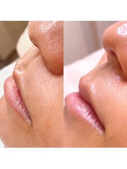 エミレ(emire)/(お口周り)フェイシャルワックス