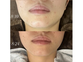 ベルバーチュプラス(Belle Virtue +)/ハーブピーリング