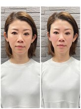 長寿鍼灸院 長寿整骨院/ハリネズミ女優美容鍼効果★