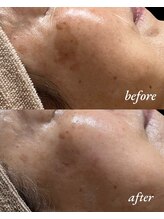 スプレミア(spuremia)/シミ症例