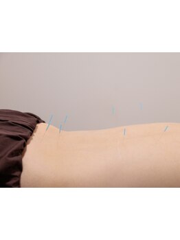 鍼灸施術を受けたい