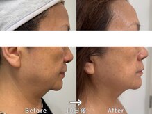 スワン 大阪南堀江(swan)/口横のぽにょ肉が気になる方