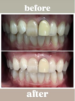 ホワイトマジック(White Magic)/before→after