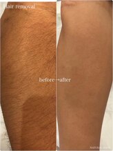 ナチュラル シャイン(NATURAL SHINE)/光脱毛