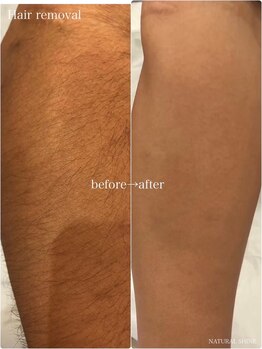 ナチュラル シャイン(NATURAL SHINE)/光脱毛