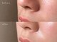 ゼロスリー(0.3s)の写真/【フェイスワックスで産毛・角質・黒ずみを撃退！】理想のつるすべ美肌に♪