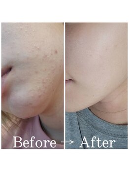 シャルム(Charme)/ニキビケア