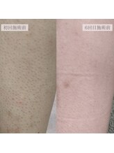 エミライ(emirai)/最新THR式脱毛で美肌脱毛