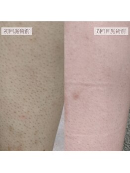 エミライ(emirai)/最新THR式脱毛で美肌脱毛