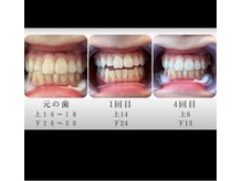 エクシアホワイトニング エミフルMASAKI店/ビフォーアフター