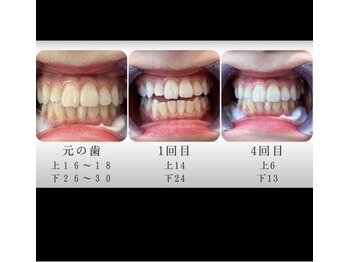 エクシアホワイトニング エミフルMASAKI店/ビフォーアフター