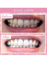エクシアホワイト 新宿御苑店(ecxia white)/ホワイトニングビフォーアフター