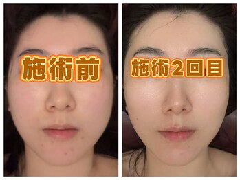 ドクタースタイル(Dr.style)の写真/ハイドラ毛穴洗浄＋ラフォス＋小顔リンパ＋超音波5000shout＆美容液導入で引き締め＆リフトUP80分¥9800