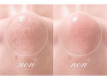 ノン(non.)の写真/【通いやすい価格×完全個室】毛穴・くすみ・肌悩みに寄り添うプライベートエステ♪