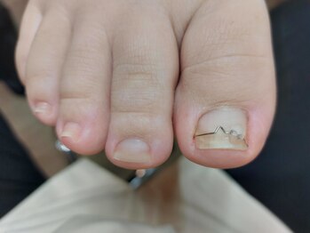 オルトグリップシュパンゲ