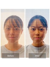 めいてる/小顔矯正/笑った時の左右差/大阪