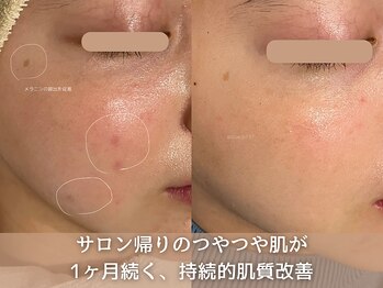 ブルーエム 大森(Blue-M)/サロン帰りのつや肌が1か月持続