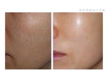 メディカルエステ 新宿南口店/＊マイクロニードル症例写真＊