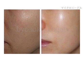 メディカルエステ 新宿南口店/*マイクロニードル症例写真*