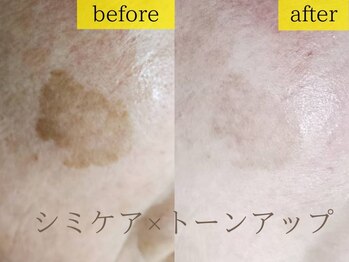 エステの森ジュジュ/【シミケア】ビフォーアフター