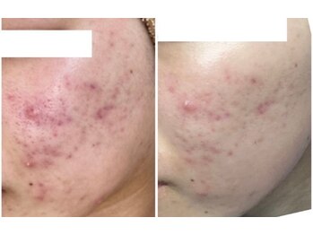 イリゼ(iriser)/ハーブピーリング