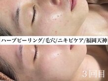 ホワイトアクア 福岡天神店(WHITE AQUA)/ハーブピーリングビフォー