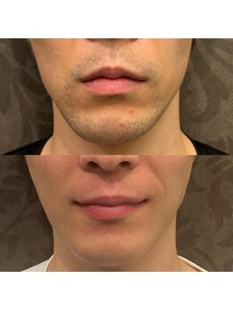 フェリーバ 流山店(FELIVA)/剃り負け、卒業しましょう