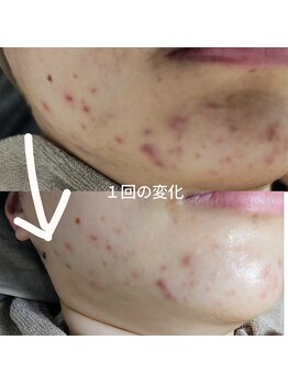 シエスタ 新小岩/しつこいニキビの鎮静に