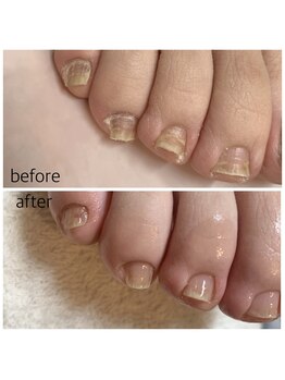 リネイル 長浜(Re-na-iL)/ネイルケア＆スパ¥7000