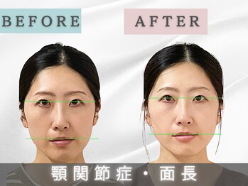 エルシンメトリー矯正院(ailesシンメトリー矯正院)/面長ビフォーアフター