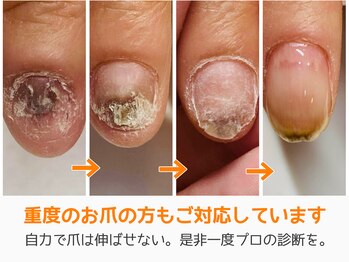 レアム/長年ずっと悩んでいた爪も綺麗に