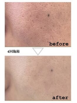 レンリー(Renry)/水光肌目指すならコレ!!