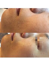 サロンシャイン(Salon Shine)/ハーバルピールレベル7