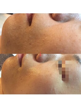 サロンシャイン(Salon Shine)/ハーバルピールレベル7