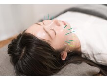 コガオ レンネ(Lenne)/小顔になれる美容鍼♪