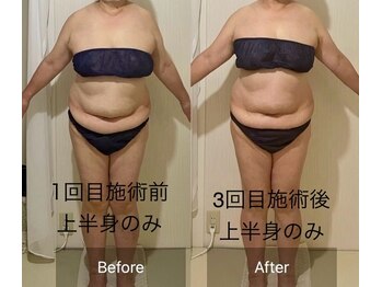 ウツク(utuku)/上半身BODYメイク　長岡/痩身