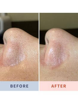 ソリス ビューティー(SOLIS BEAUTY)/毛穴洗浄