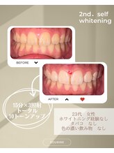 スリール(sourire)/ビフォーアフター