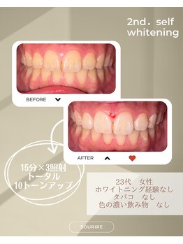 スリール(sourire)/ビフォーアフター