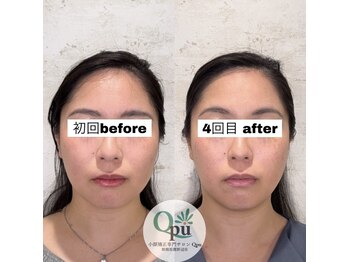 キュープ 相模原淵野辺店(Qpu)/たった4回で人生で1番小さな顔に