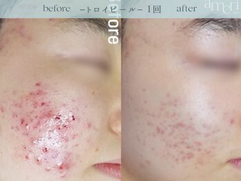 スキンラボアメリ(skin lab. ameri)/お悩み…赤みニキビ凹凸毛穴