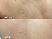 ベルマージュ 四日市(Bell Mage)/肌質改善/毛穴ケア/ニキビ