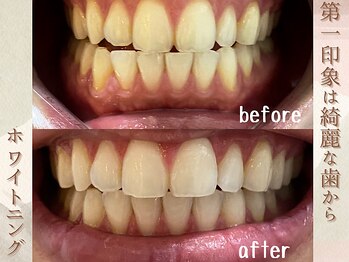 ラナ(LaNa)/第一印象は綺麗な歯から!